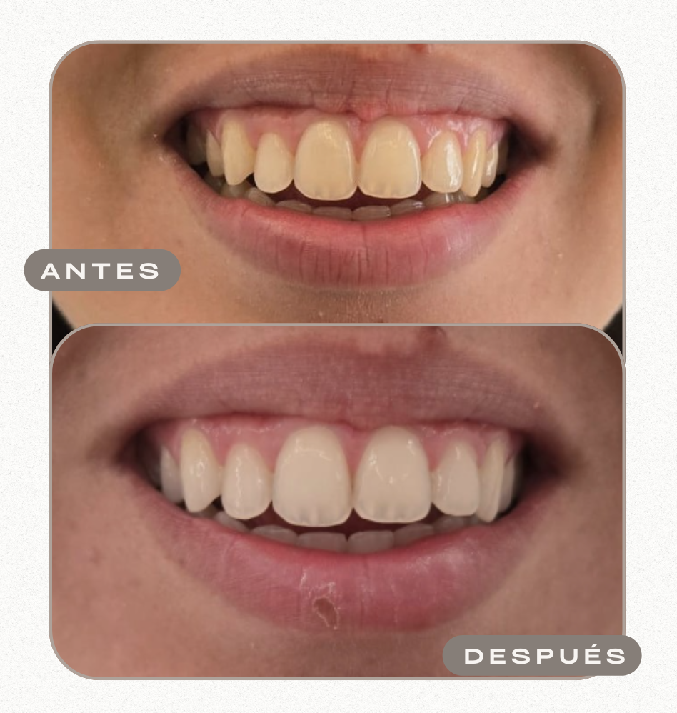 Blanqueamiento dental